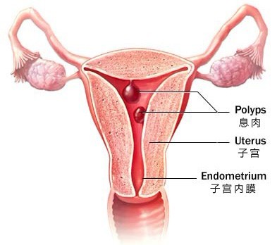 宫颈息肉临床结构图