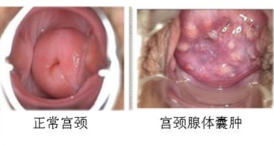 宫颈囊肿