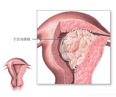 子宫内膜炎